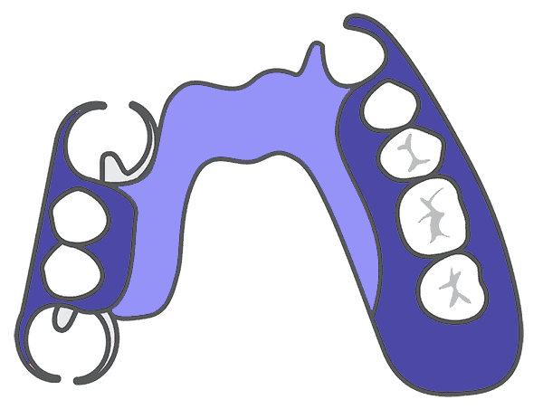 Cast Metal Removable Dentures