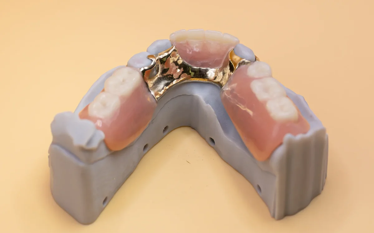 Acrylic interim partial denture at the IDA bench