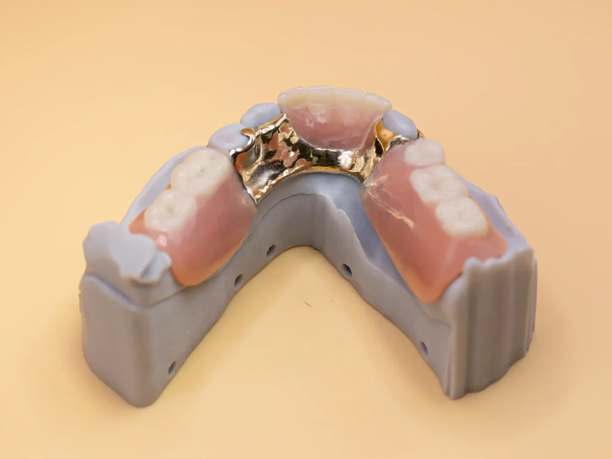 Acrylic interim partial denture at the IDA bench