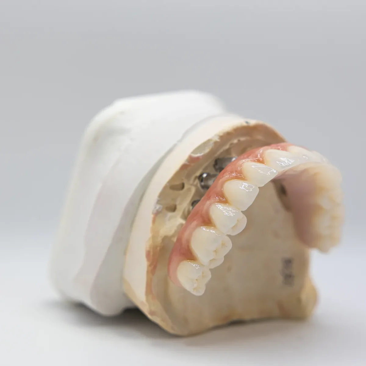 Mandibular implant overdenture from the side