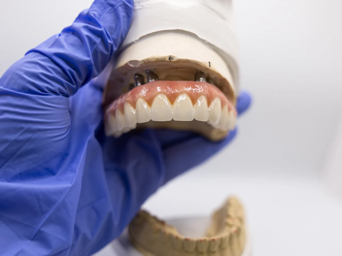 Maxillary all-on-x screw-retained prosthesis