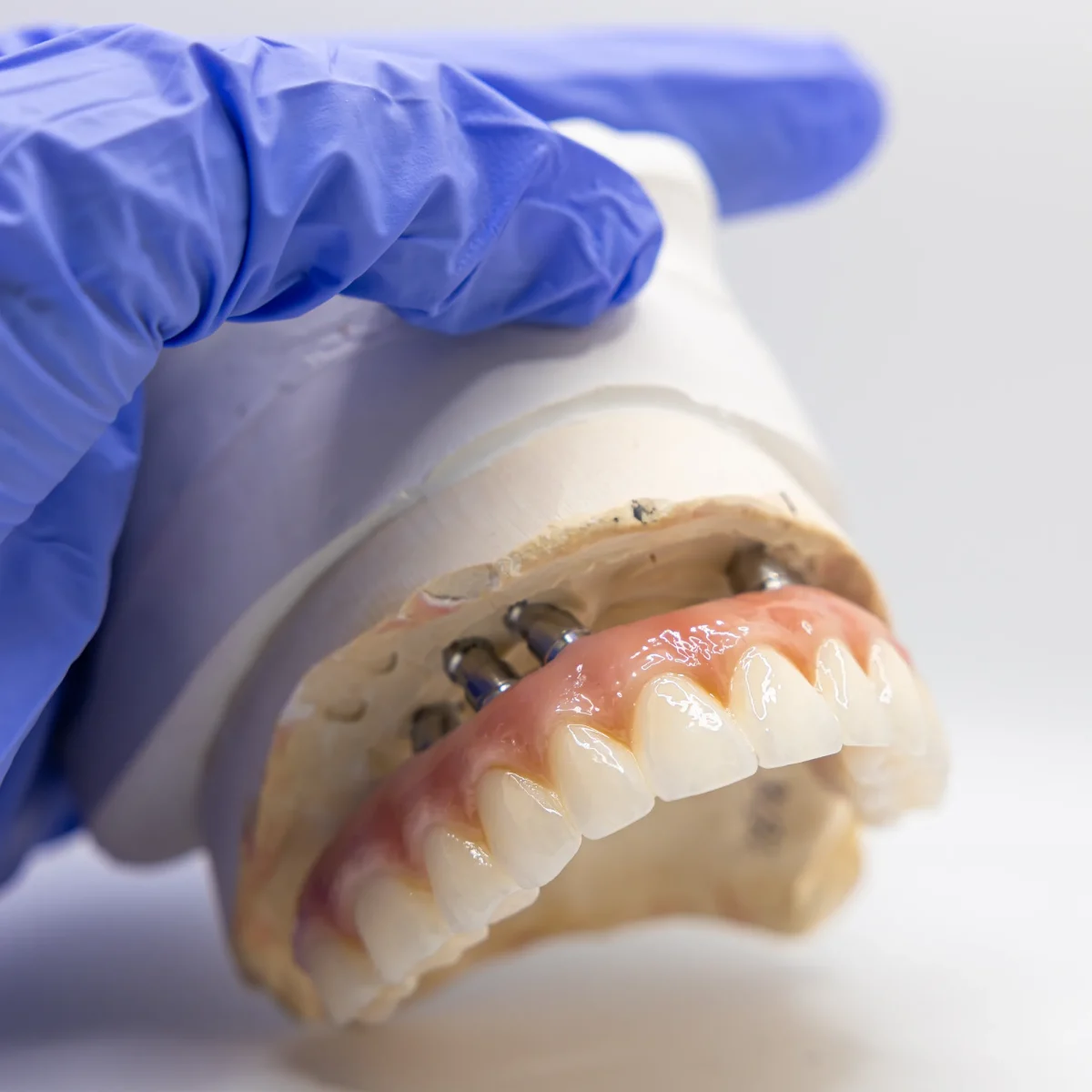 All-on-X occlusal screw channels at the IDA bench