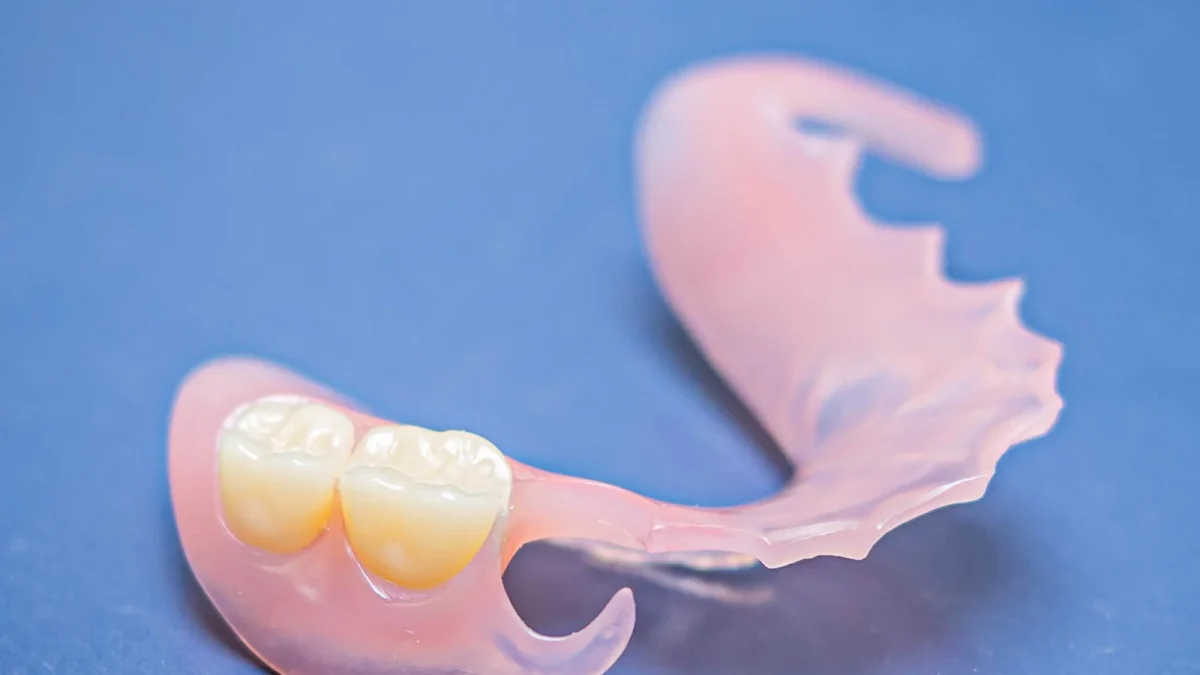 Flexible thermoplastic partial denture whose retentive clasps carry no visible metal