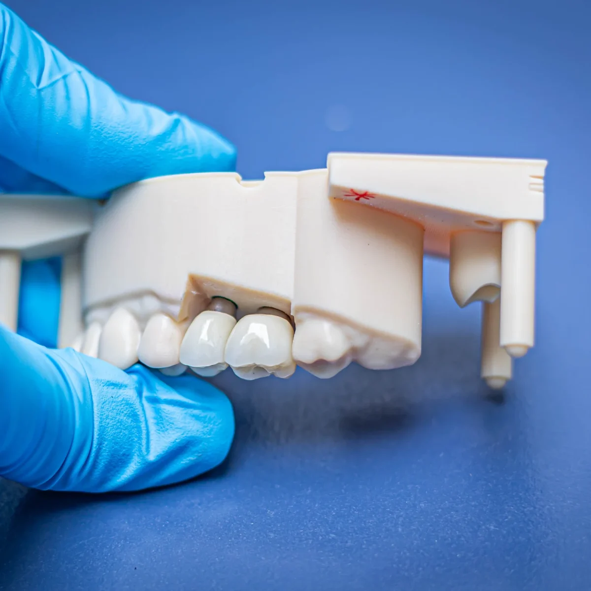 Implant crowns on a model held in a gloved hand