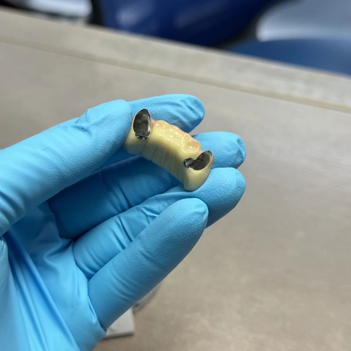PFM crown on model with metal margin detail