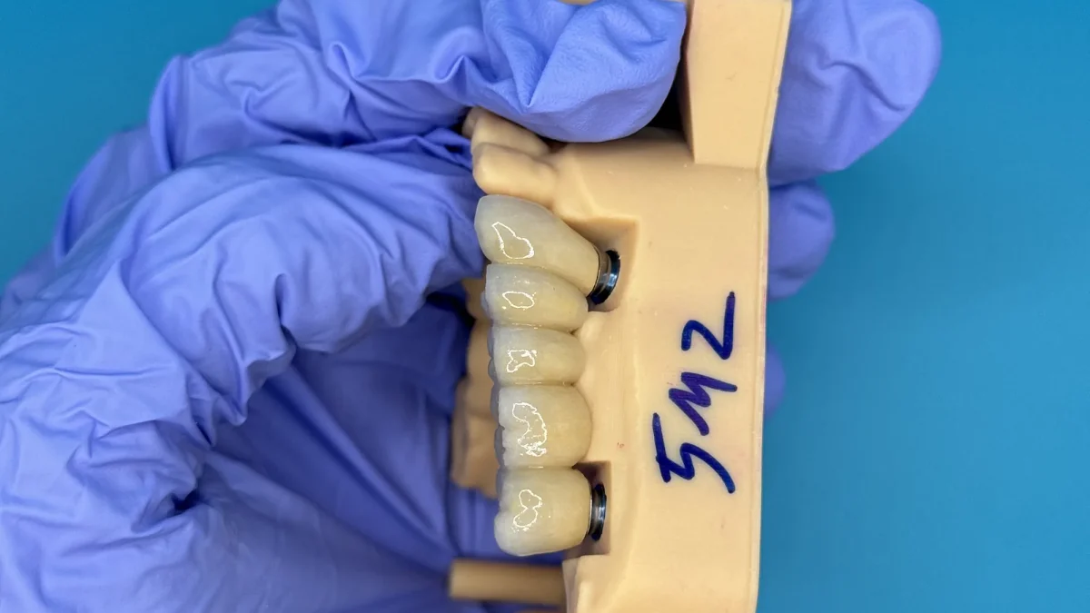 Five-unit screw-retained implant bridge on a model, screw channels planned into the design