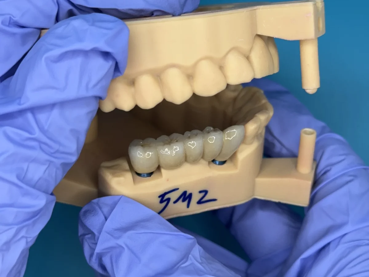Screw-retained bridge, side view
