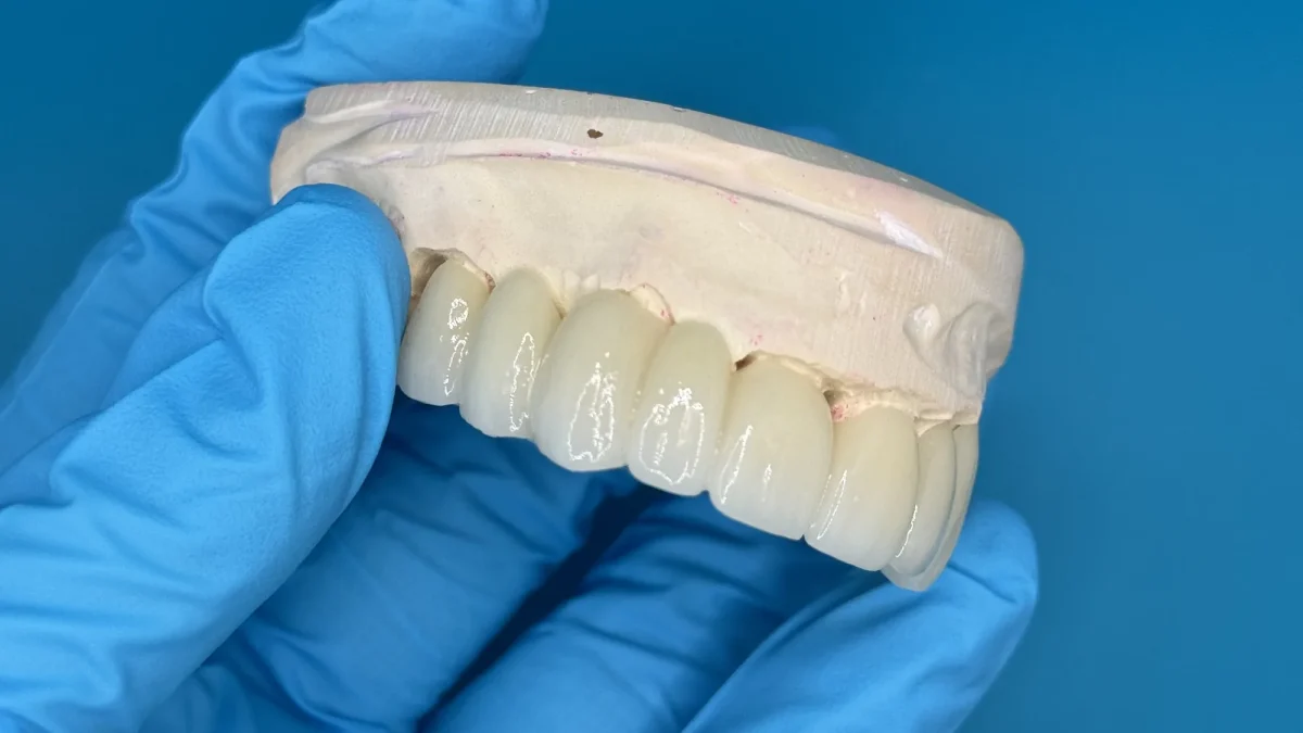 Monolithic anterior zirconia bridge on a maxillary model, incisal embrasures visible