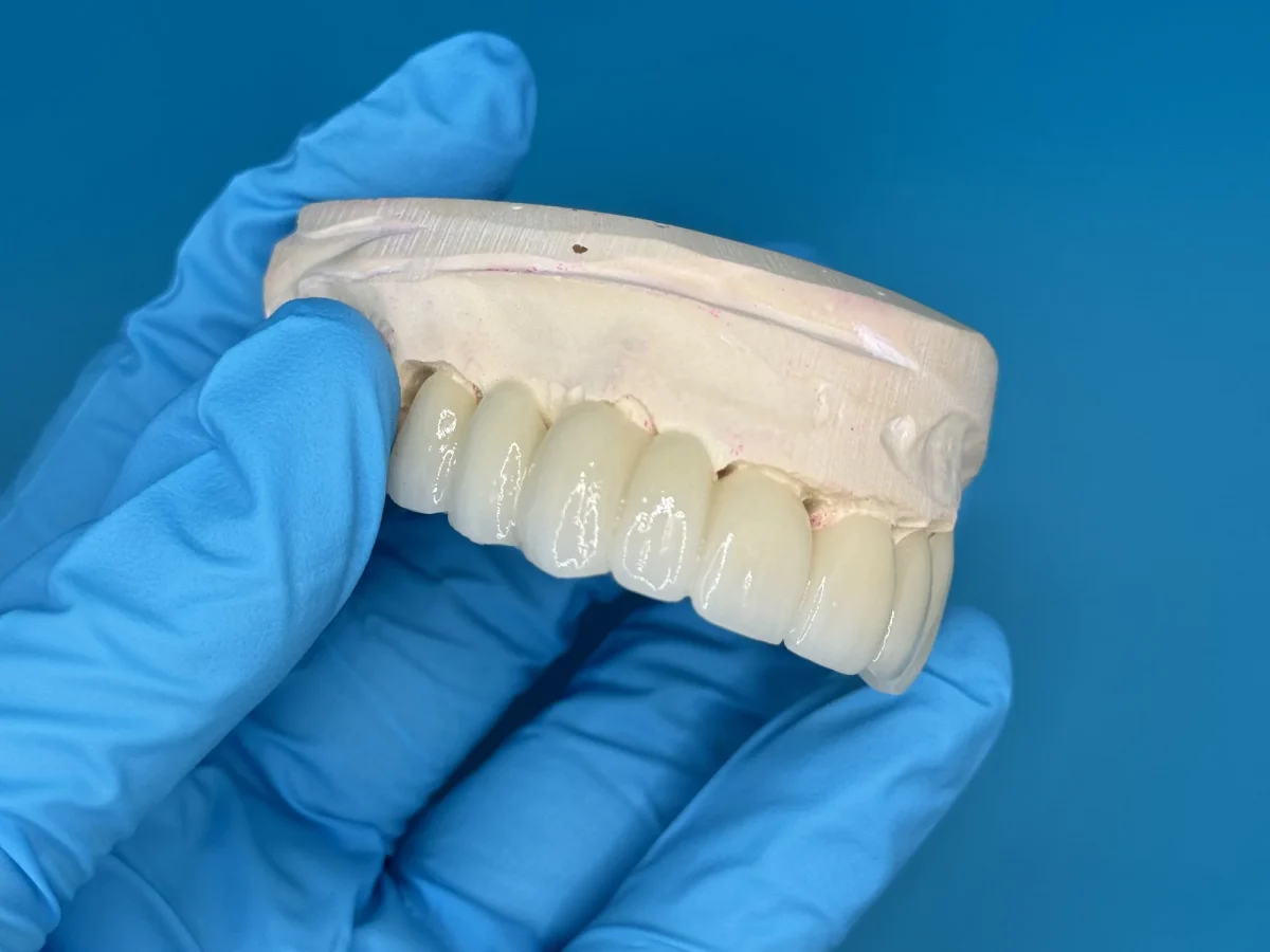 Monolithic anterior zirconia bridge
