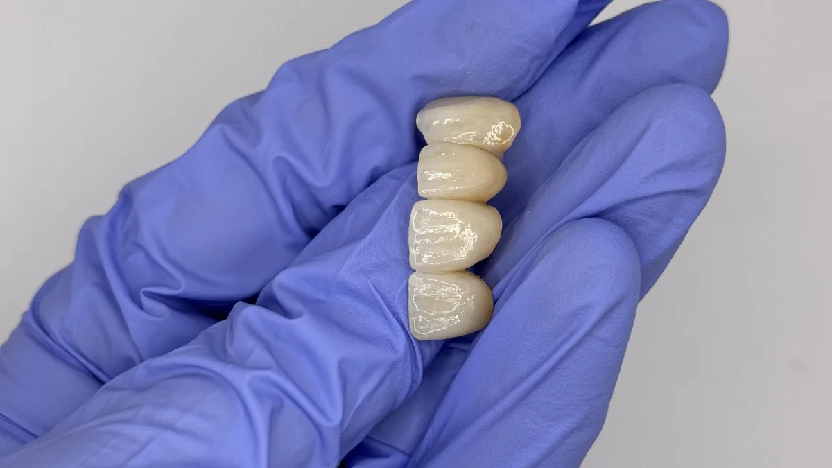 Long-span posterior monolithic zirconia bridge with the connectors between units visible