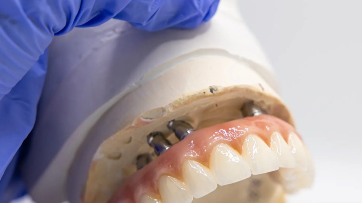 Occlusal screw access channels on a finished full arch implant prosthesis