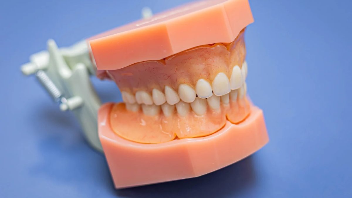 Upper and lower arches articulated in occlusion, the reference a full coverage occlusal splint is built against