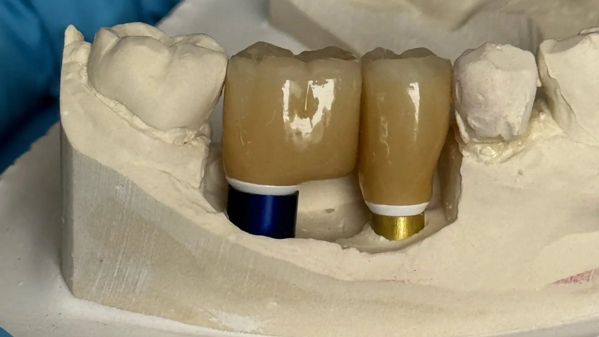Two anterior implant crowns seated on anodised custom titanium abutments, one blue and one gold, on a stone working model