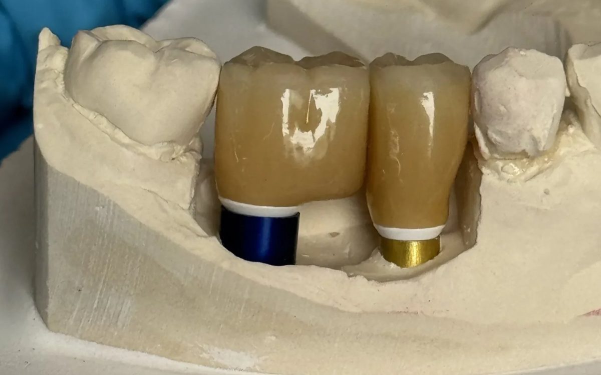 Two anterior implant crowns seated on anodised custom titanium abutments, one blue and one gold, on a stone working model