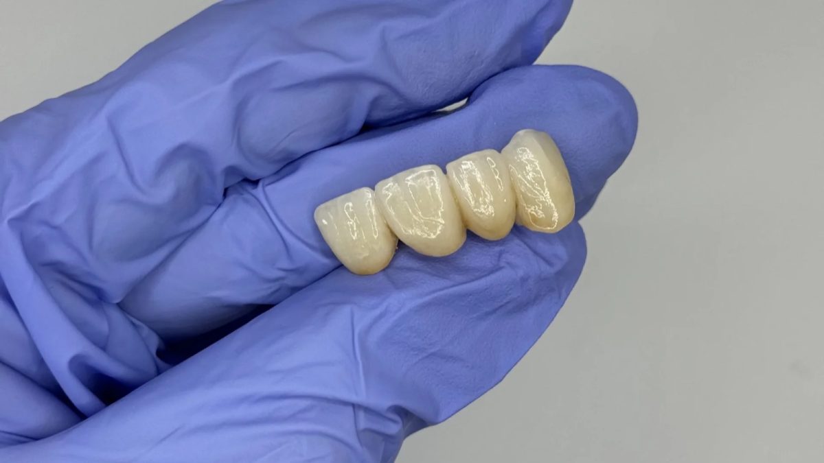 Full-arch monolithic zirconia implant prosthesis at the IDA bench