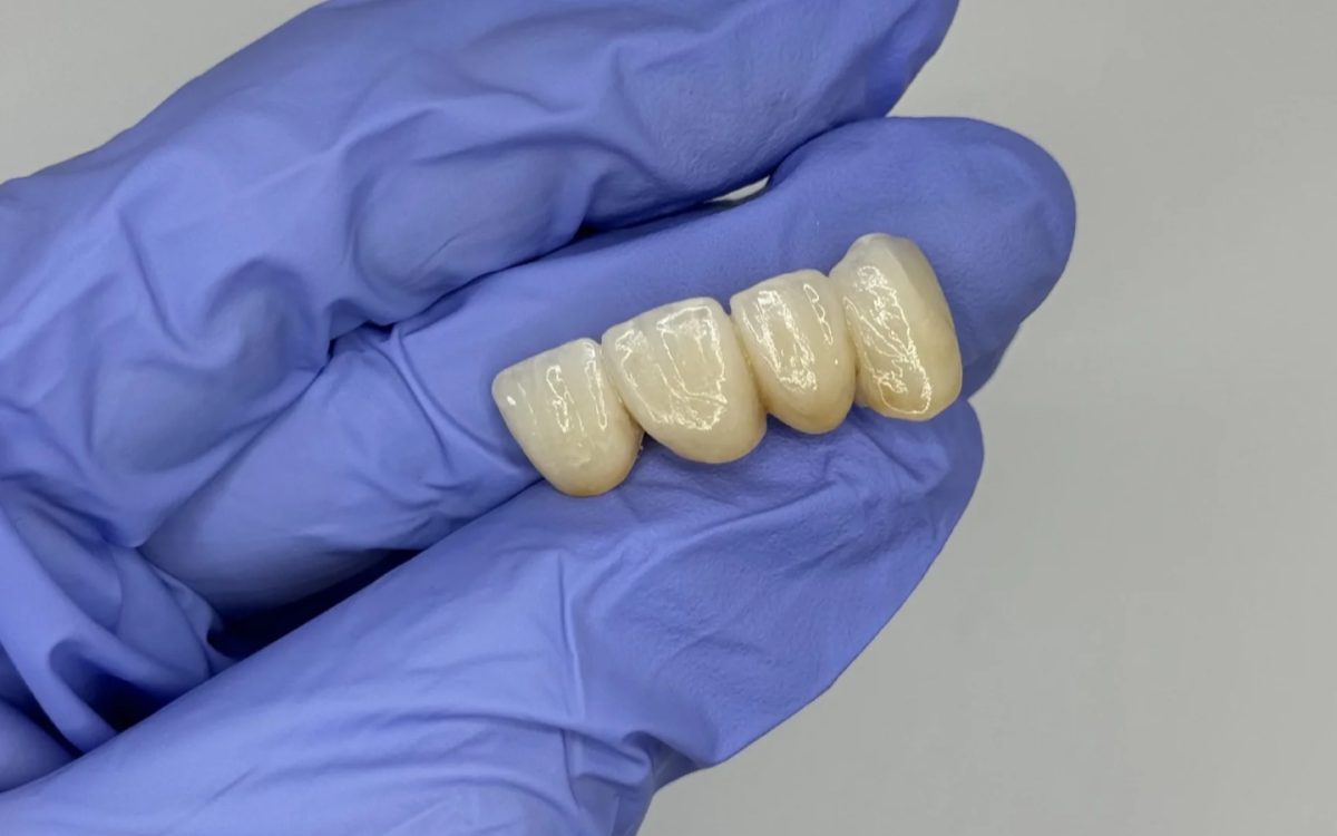 Full-arch monolithic zirconia implant prosthesis at the IDA bench