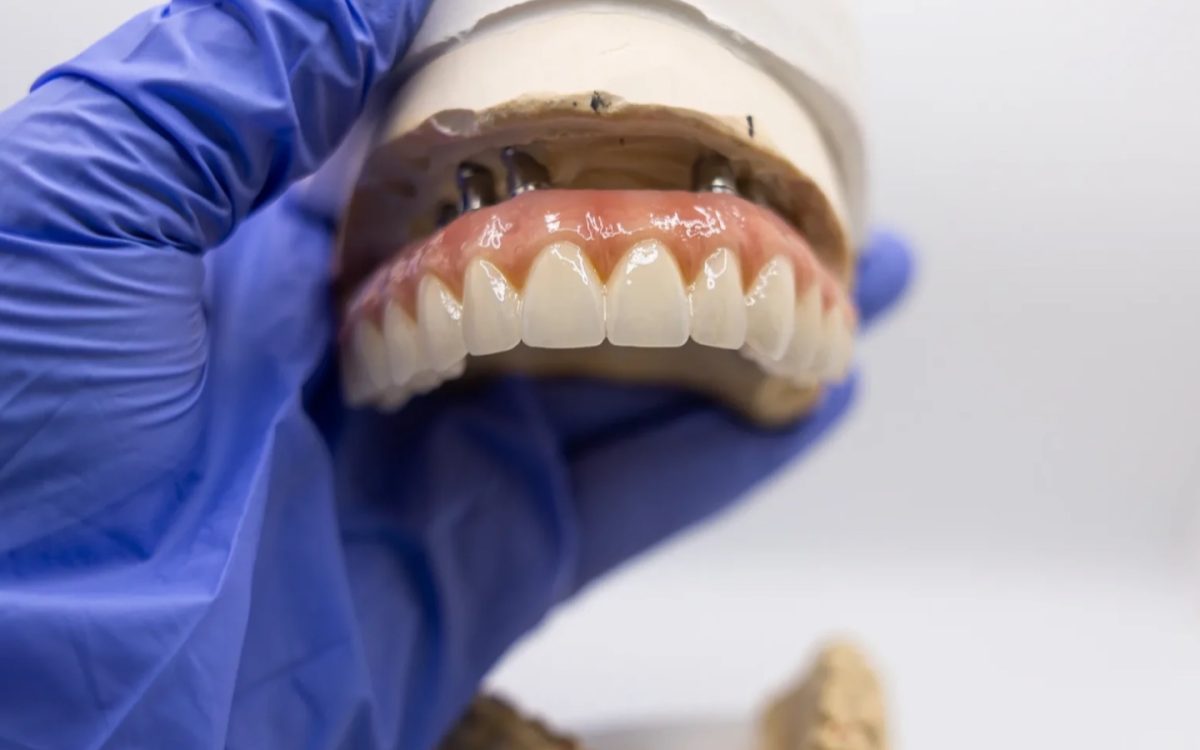 Maxillary All-on-X screw-retained full-arch prosthesis at the IDA bench