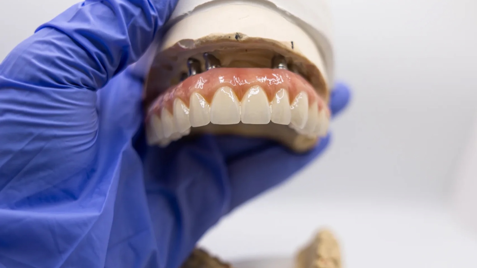 Maxillary full arch screw retained prosthesis with visible access channels, seated on the master cast at IDA