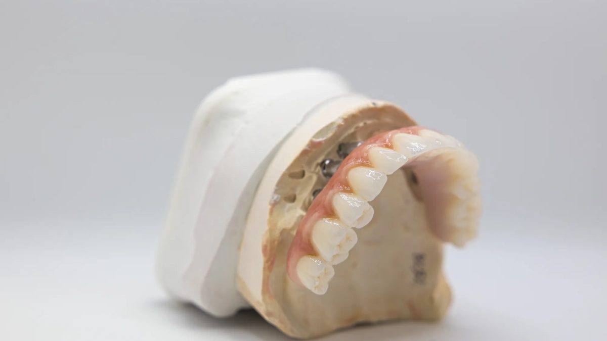 Full-arch implant prosthesis lifted off multi-unit abutments on a cast at the IDA bench