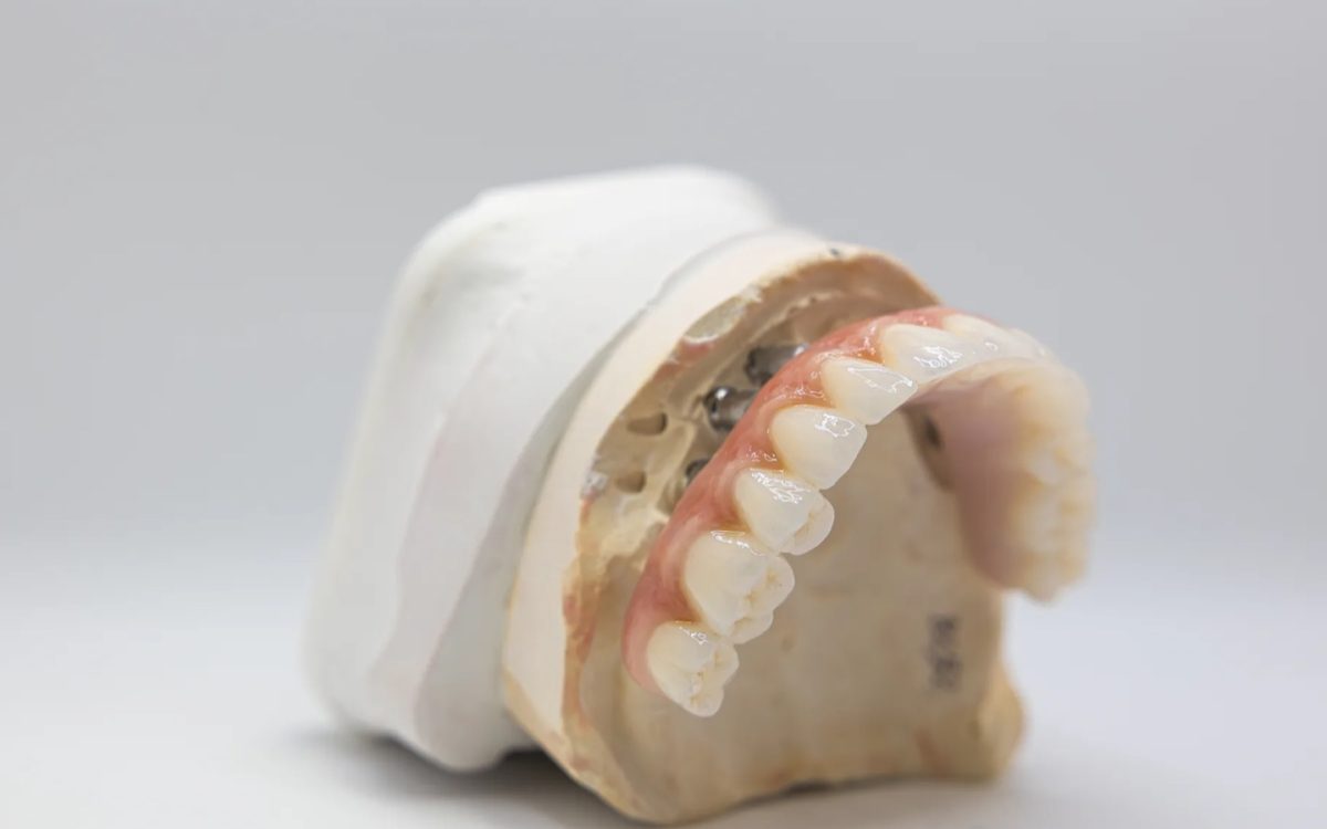 Full-arch implant prosthesis lifted off multi-unit abutments on a cast at the IDA bench