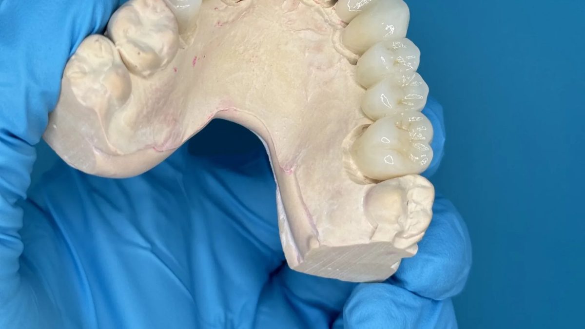 Long-span monolithic zirconia bridge seated on a mandibular model at the IDA bench