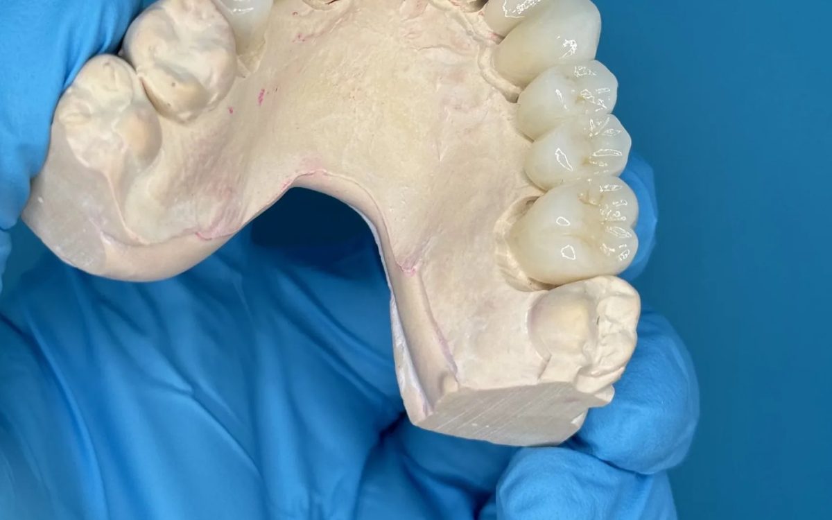 Long-span monolithic zirconia bridge seated on a mandibular model at the IDA bench