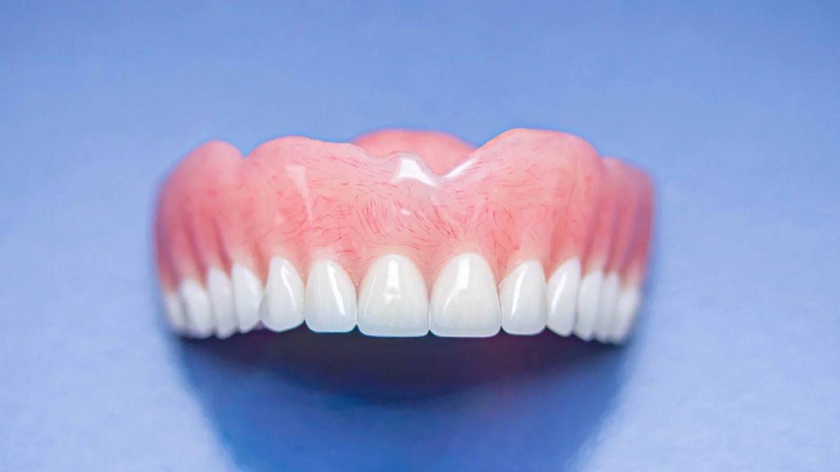 Digitally printed upper denture at the IDA bench, the workflow used for an immediate denture case
