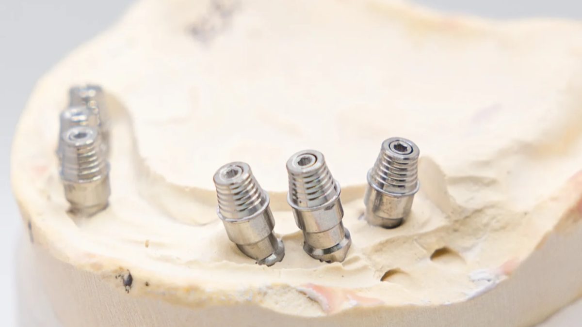 Multi-unit abutments on a master cast for full arch dental implants at the IDA bench