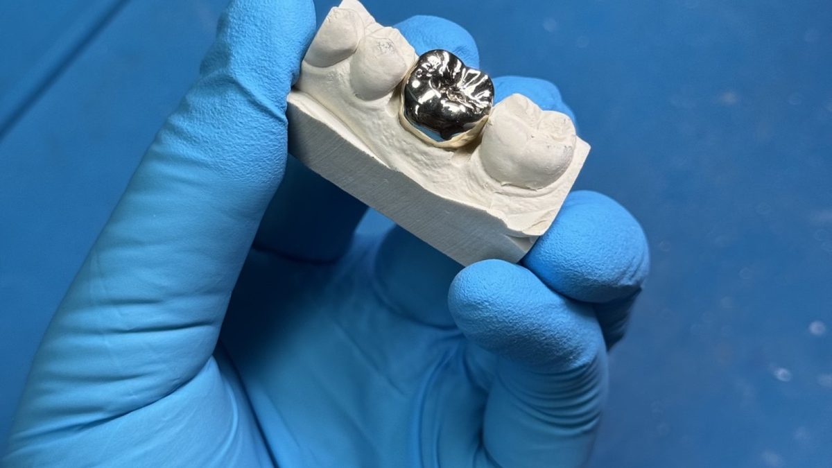 Screw-retained implant crown on a model with the occlusal screw access channel visible, at the IDA bench