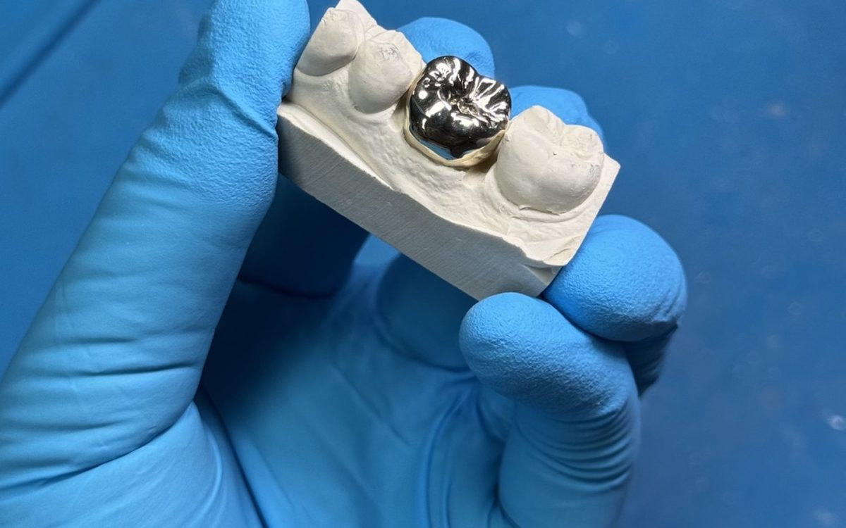Screw-retained implant crown on a model with the occlusal screw access channel visible, at the IDA bench