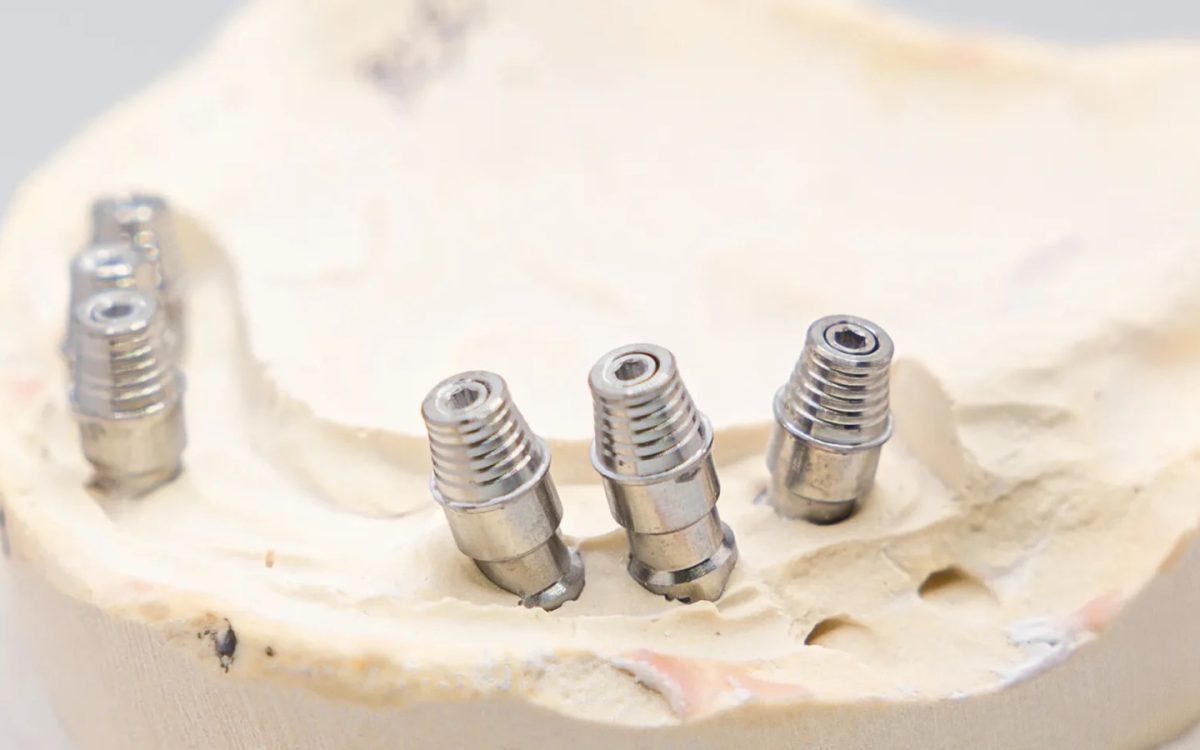 Multi unit abutments seated on a full arch master cast at the IDA laboratory