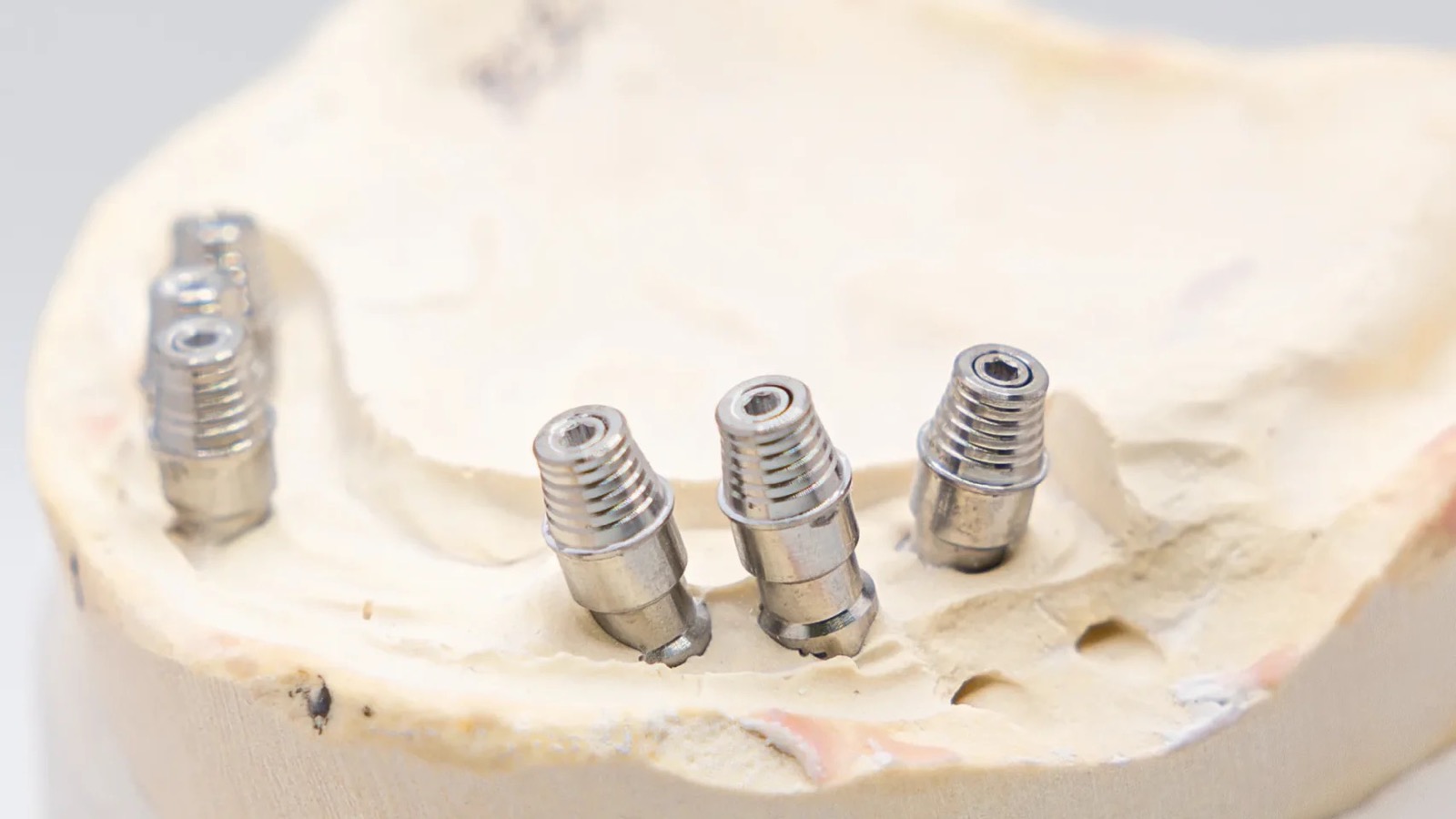 Implant components seated on a master cast at the IDA laboratory, the position an implant scan body is used to capture digitally