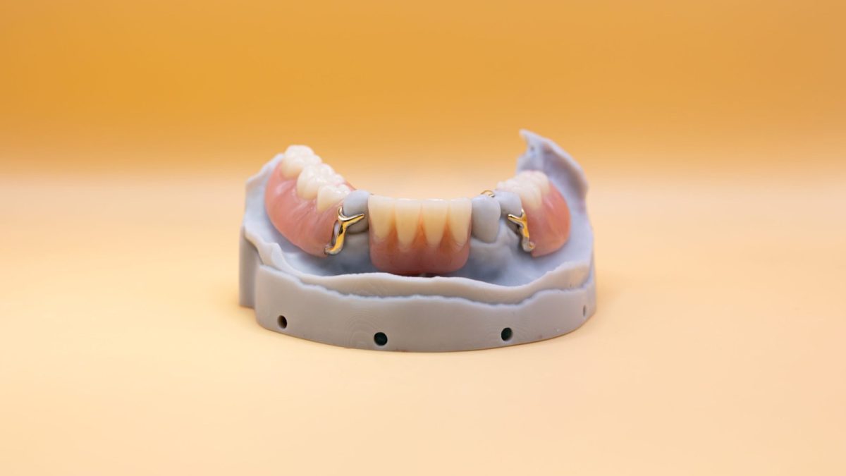 Lower partial denture with metal clasps seated on a master cast at the IDA laboratory
