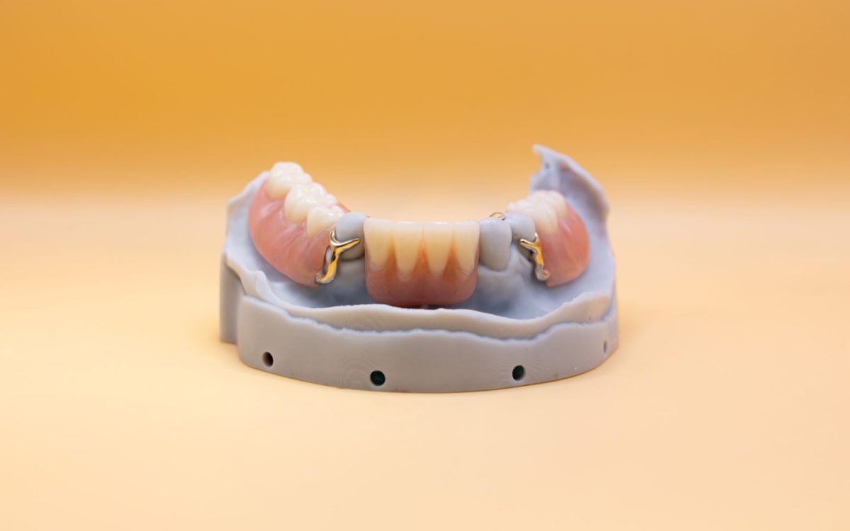 Lower partial denture with metal clasps seated on a master cast at the IDA laboratory