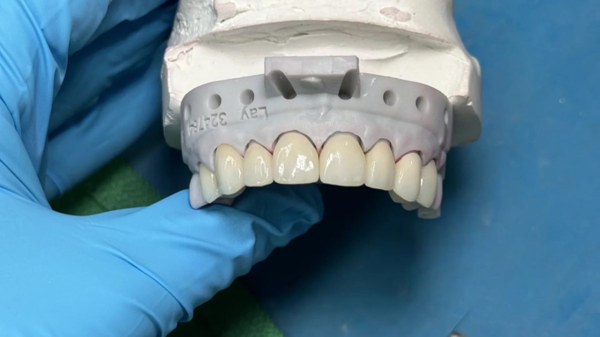 Anterior zirconia restoration on a stone model at IDA, where the chamfer margin is traced before design