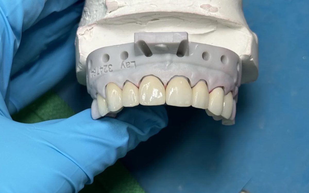 Anterior zirconia restoration on a stone model at IDA, where the chamfer margin is traced before design