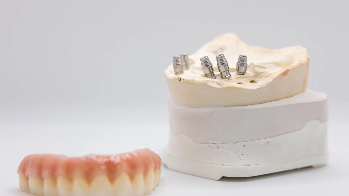 Implant analog set in a stone cast beside a full denture at the IDA lab, four multi-unit positions
