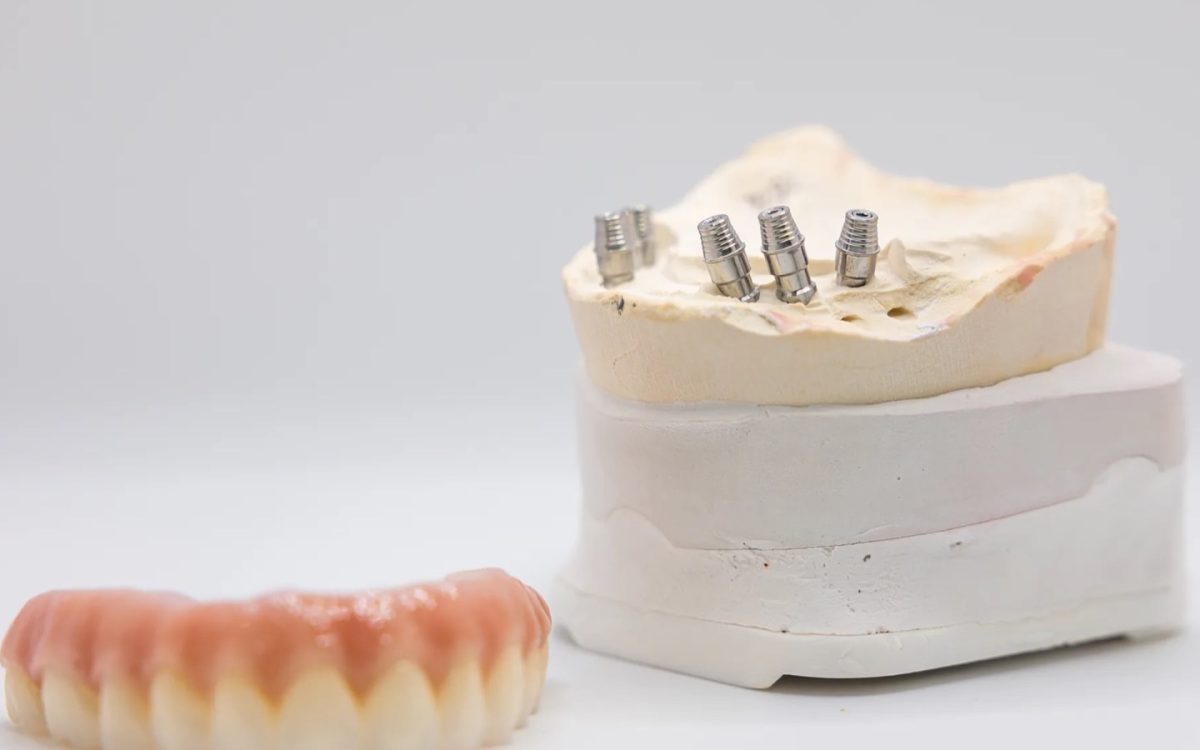 Implant analog set in a stone cast beside a full denture at the IDA lab, four multi-unit positions