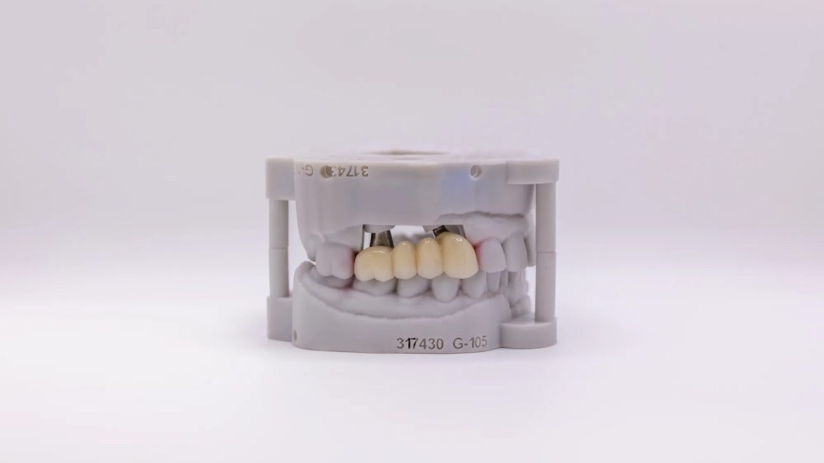 Implant bridge on an articulated printed model at IDA, built from the positions each impression coping recorded