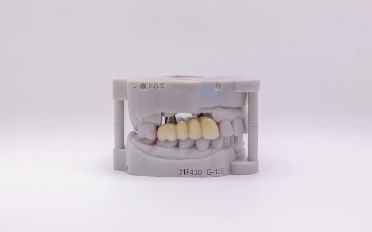 Implant bridge on an articulated printed model at IDA, built from the positions each impression coping recorded