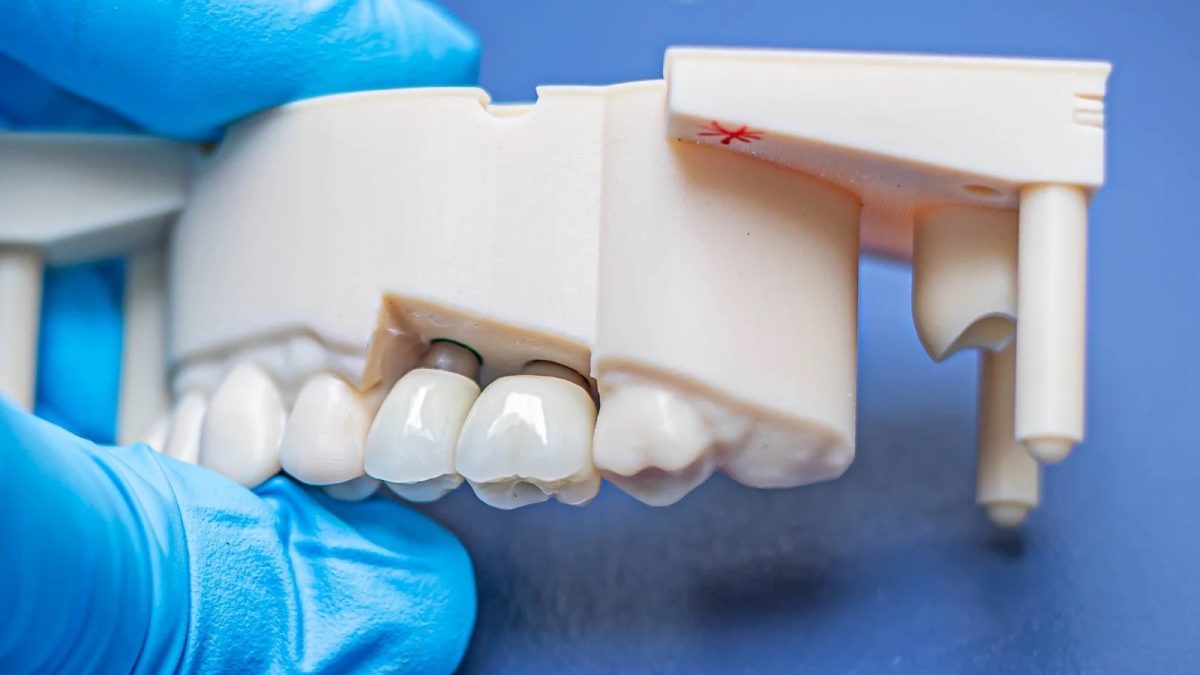 Implant crowns on a printed model in a gloved hand, a single-unit case for an open tray vs closed tray impression