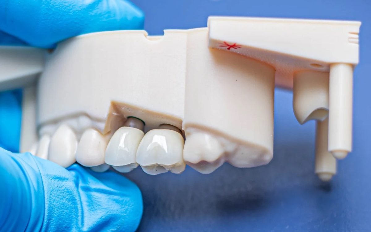 Implant crowns on a printed model in a gloved hand, a single-unit case for an open tray vs closed tray impression