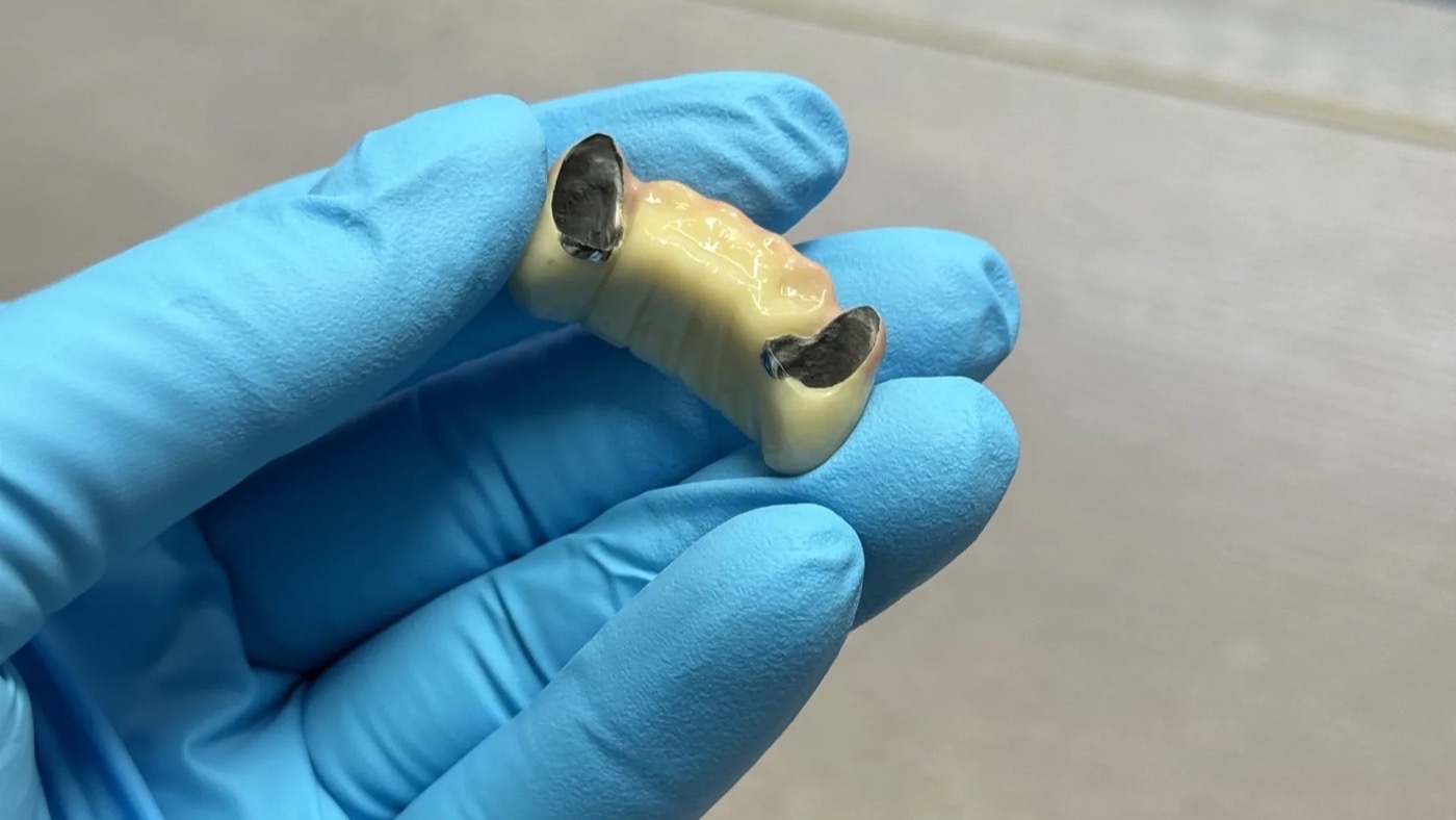 Porcelain fused to metal bridge held in a gloved hand at IDA, with the metal substructure visible at the retainer ends